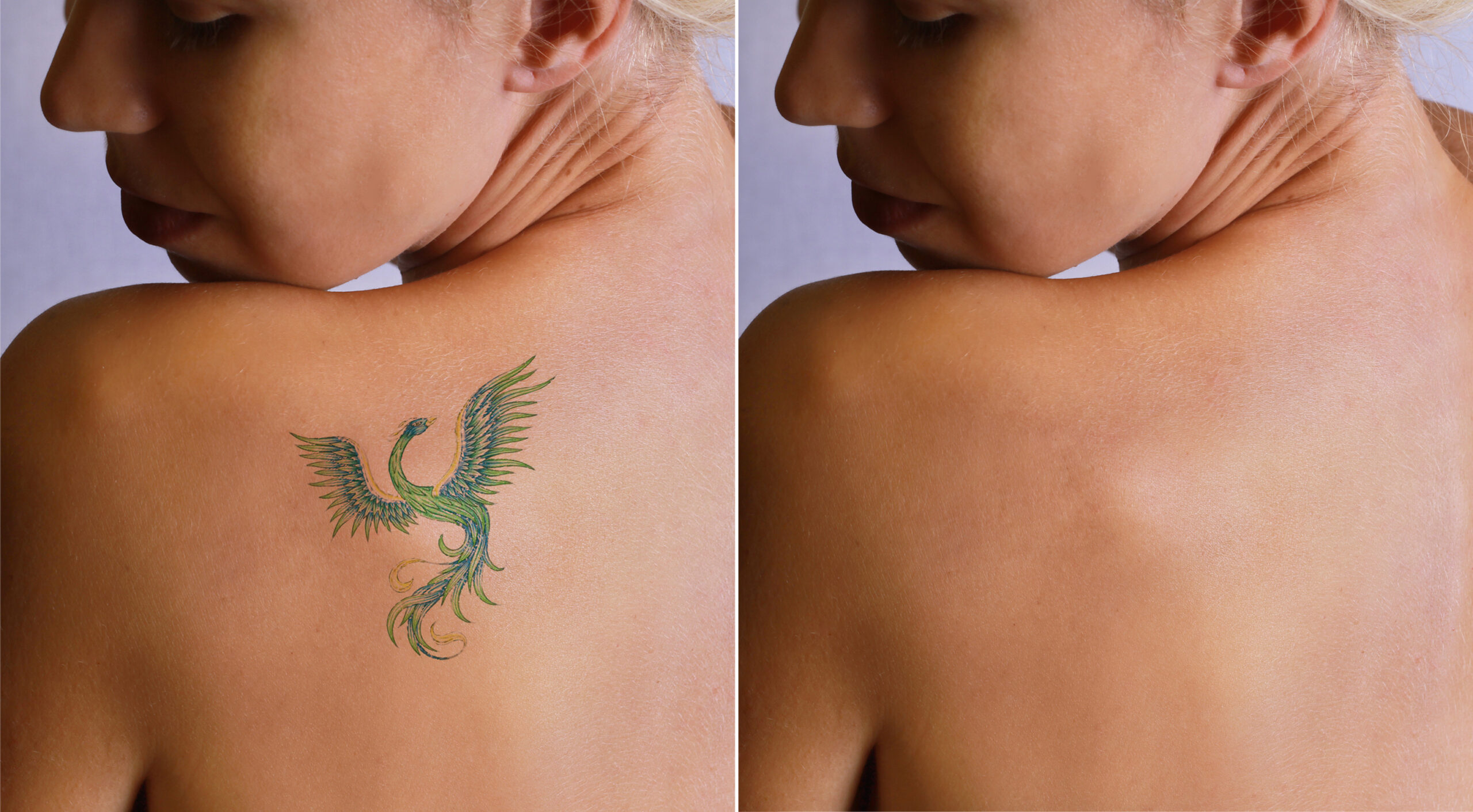 Tattoo Removals