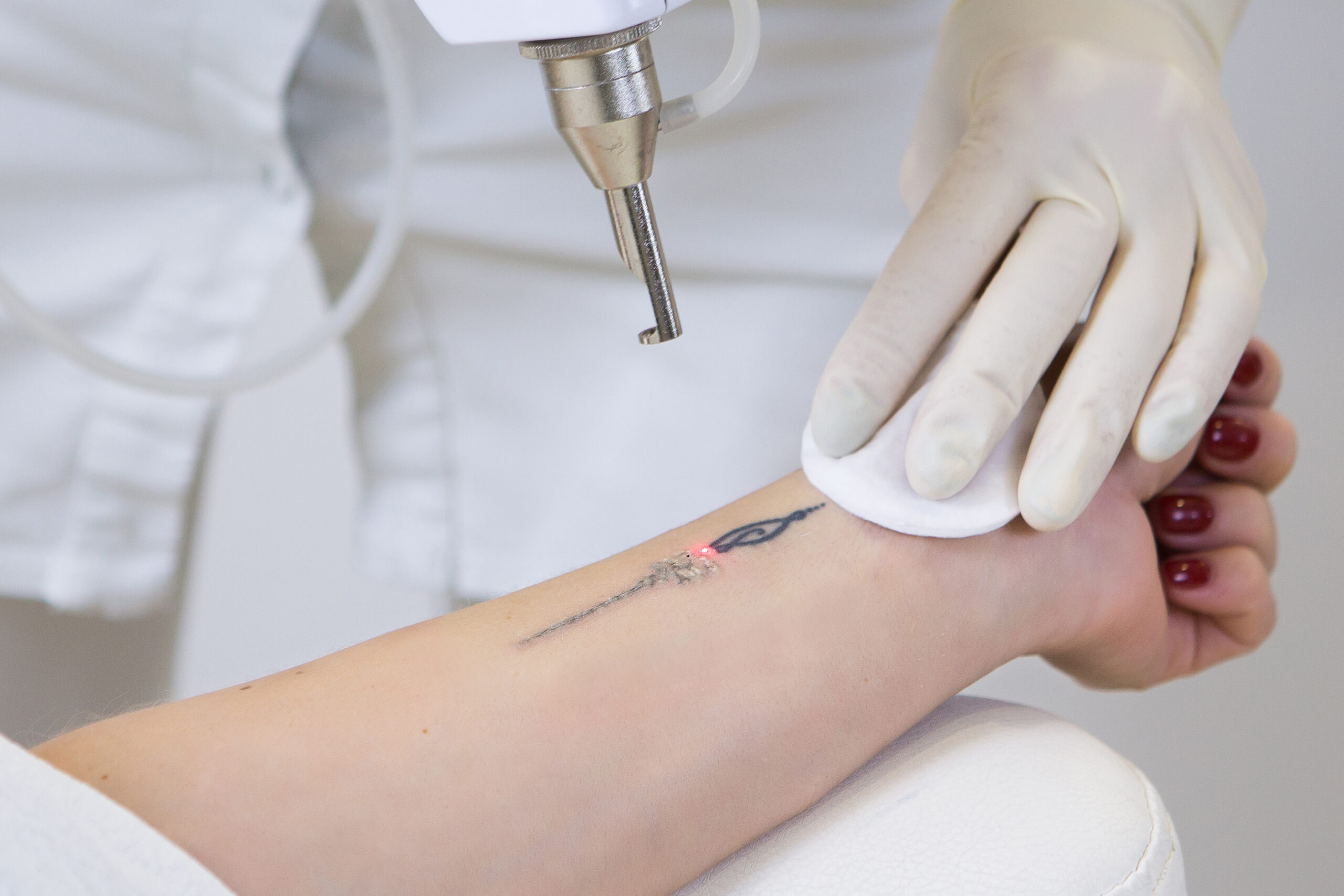 Laser Tattoo Removals