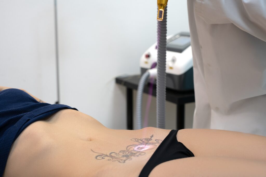 Laser Tattoo Removal
