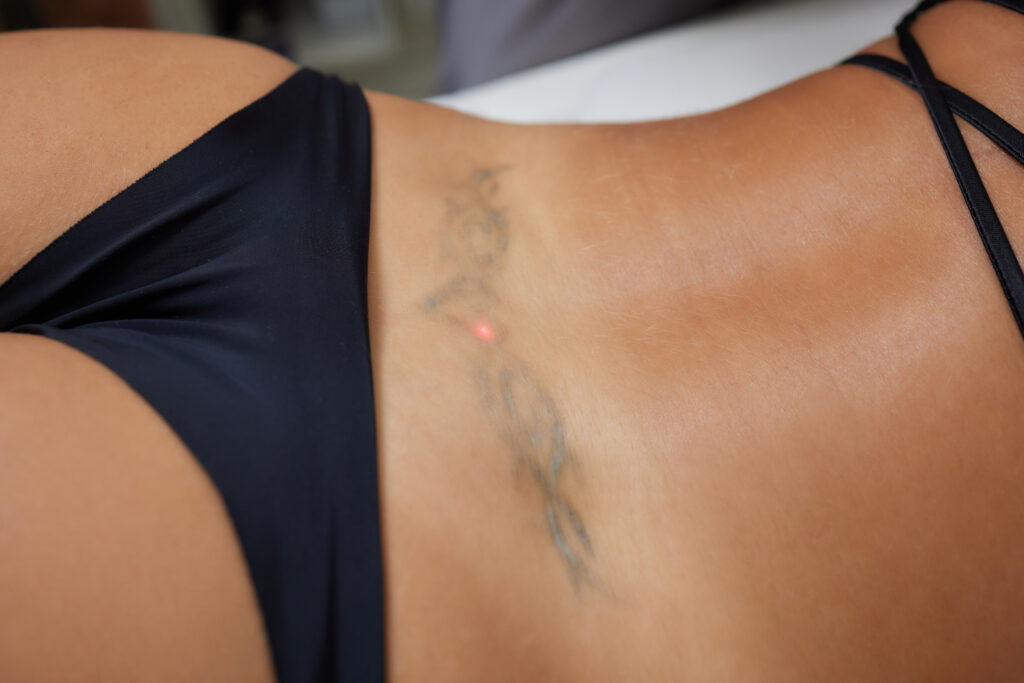 Tattoo Removals In Yarm
